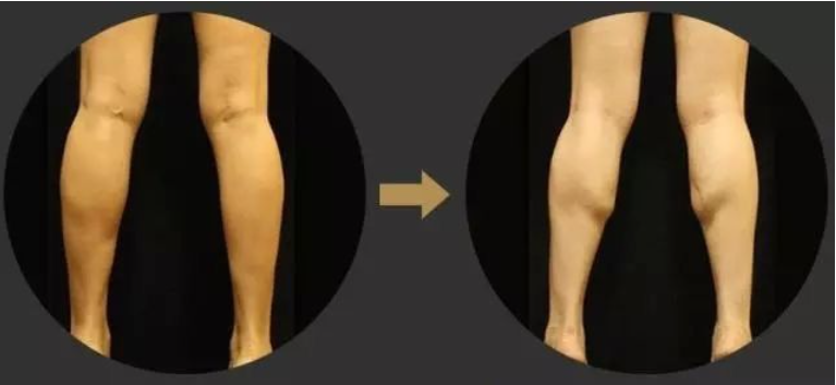 判断肌肉腿脂肪腿水肿腿_瘦的人血脂高是什么原因_瘦小腿不同类型方法