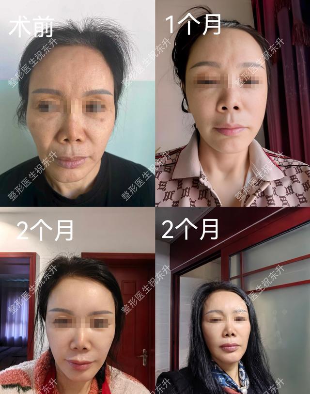 电波拉皮除皱做几次能除皱_退休金医美消费趋势分析_50+医美面部提升手术安全正规医院