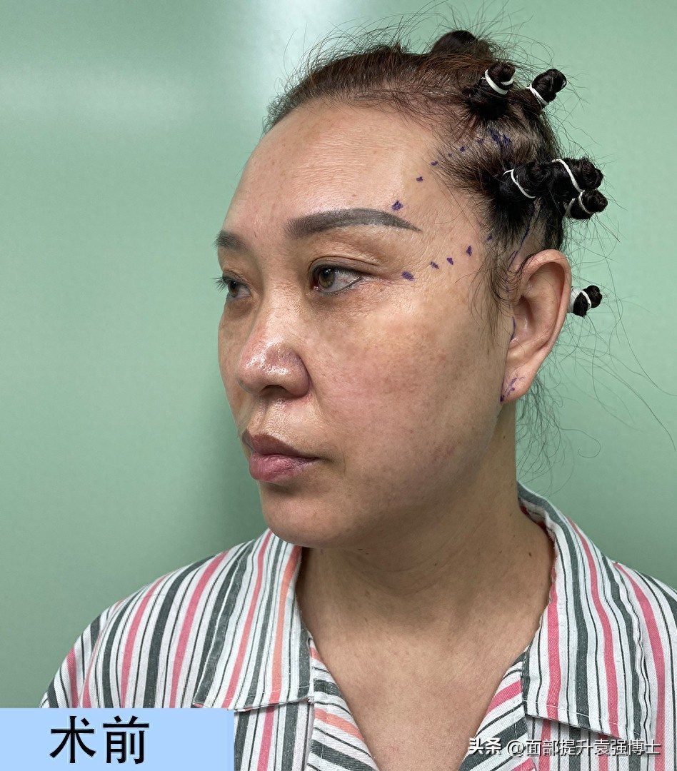 拉皮手术前后对比_拉皮手术恢复过程_电波拉皮除皱做几次能除皱