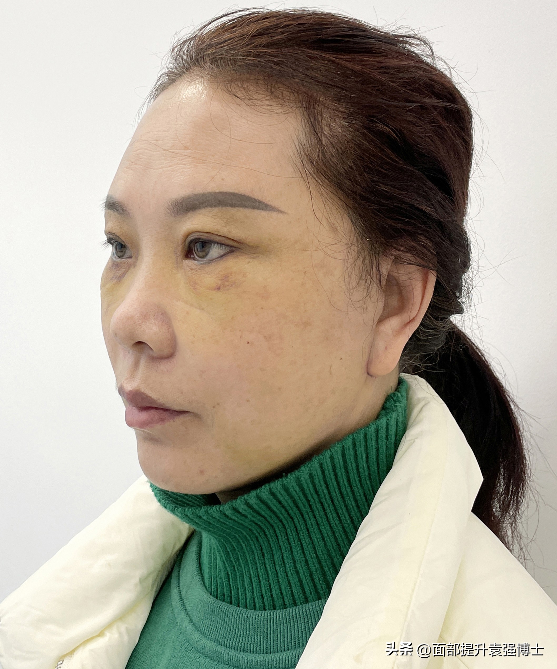 拉皮手术前后对比_拉皮手术恢复过程_电波拉皮除皱做几次能除皱