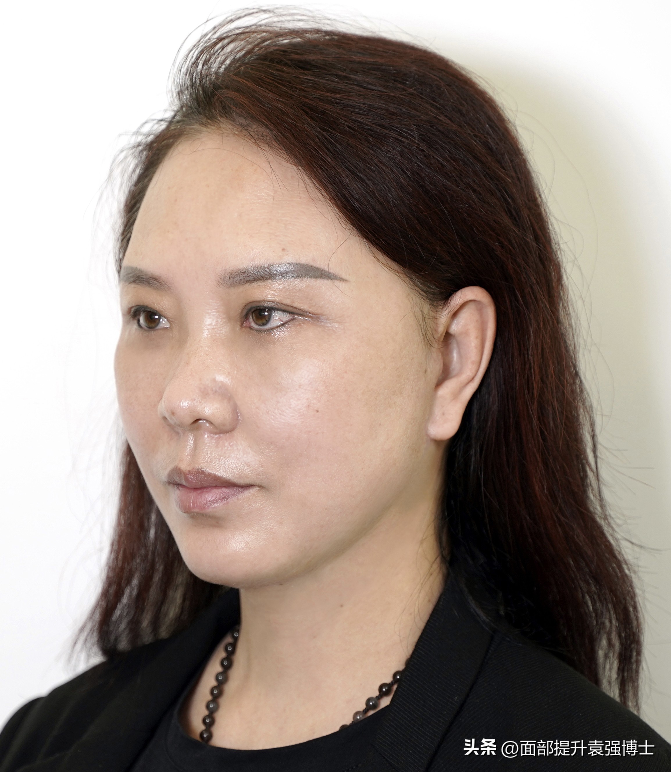 电波拉皮除皱做几次能除皱_拉皮手术恢复过程_拉皮手术前后对比