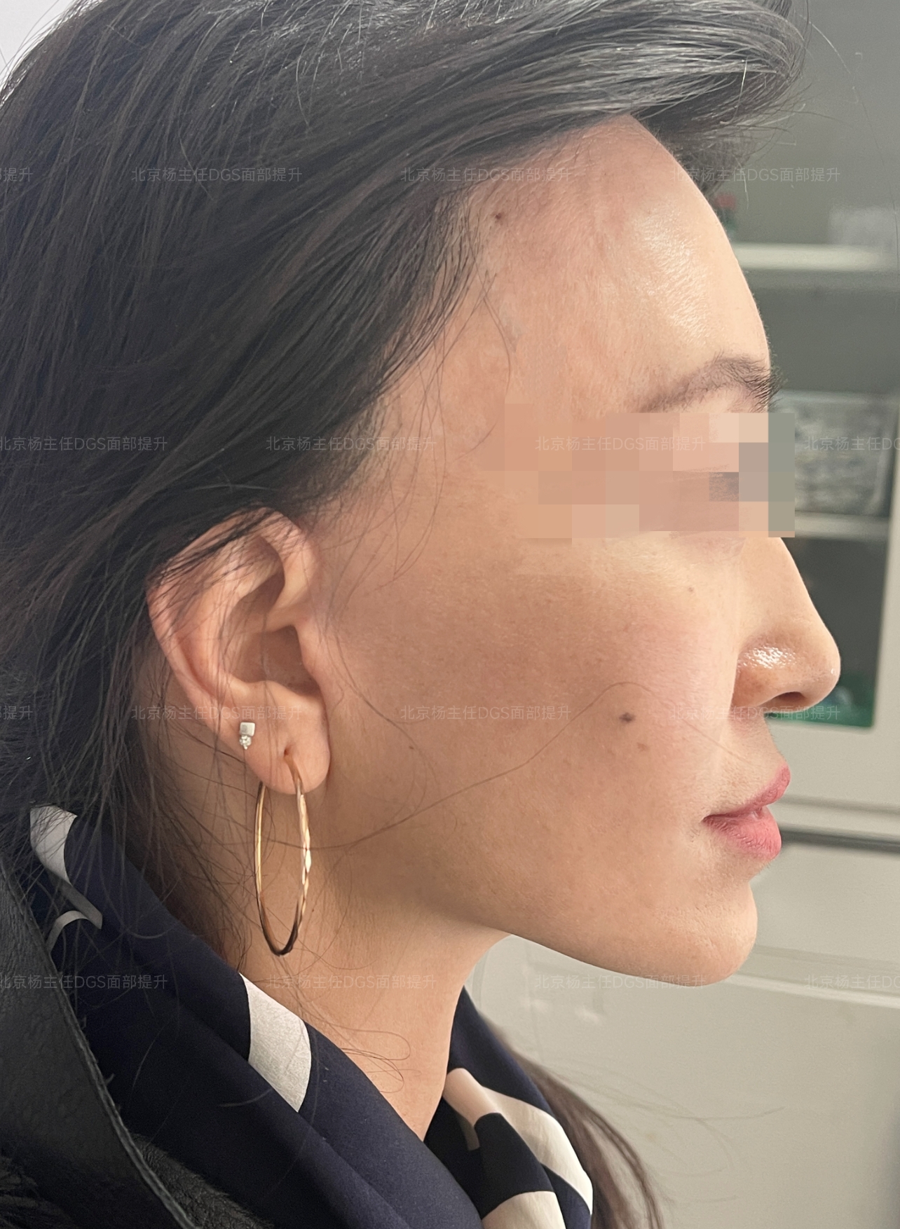 电波拉皮除皱做几次能除皱_面部提升手术_北京面部提升医院