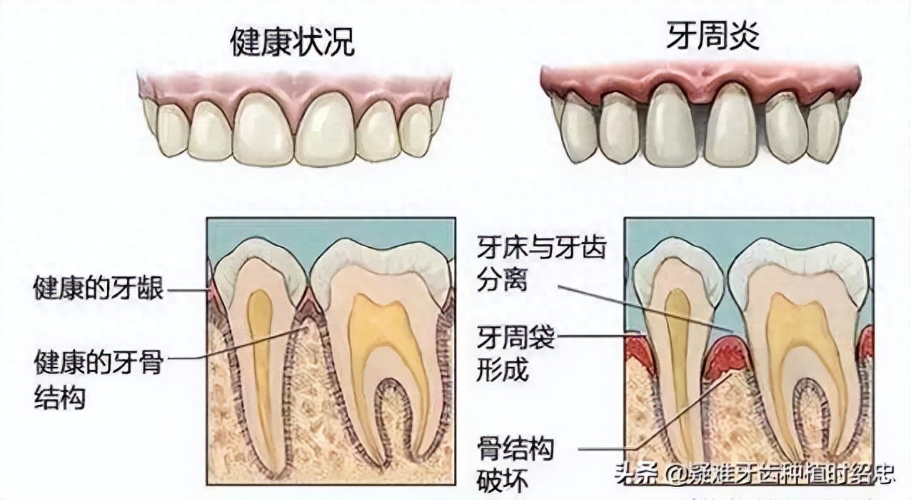牙龈炎_牙龈炎治疗_吸烟牙齿变黑能洗掉吗