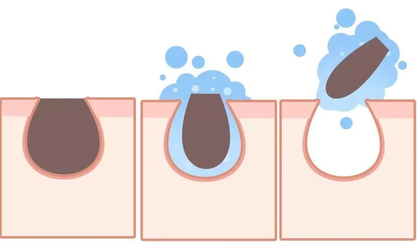 黑头成因及解决方法_科学祛黑头步骤_用盐去黑头的正确方法