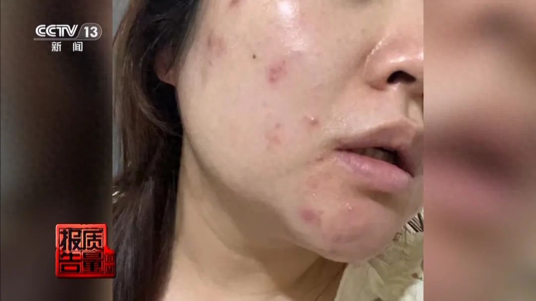 美容院做脸部护理好吗_针清祛痘危害_美容院祛痘