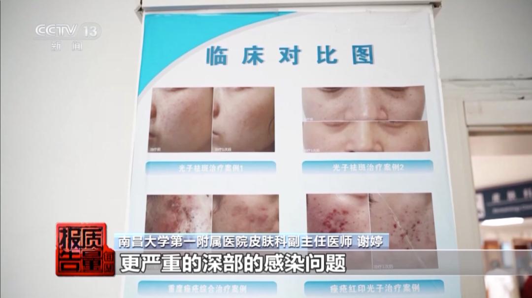 针清祛痘危害_美容院祛痘_美容院做脸部护理好吗