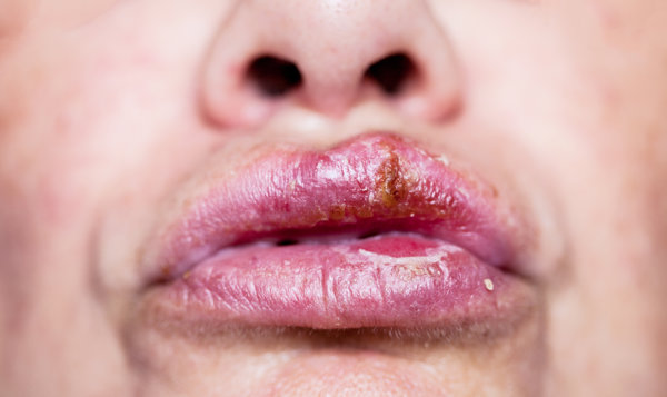 嘴唇肿食用食物_消肿食物推荐_嘴巴肿了能吃什么食物