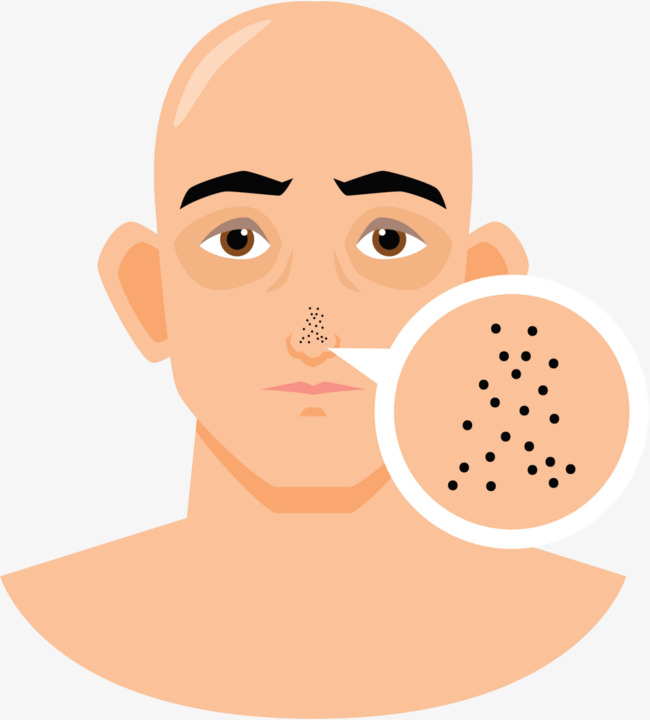 用盐去黑头的正确方法_黑头成因与去除方法_科学护肤黑头解决方案